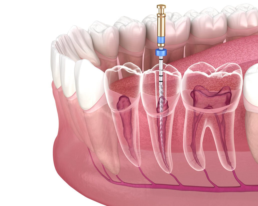 ¿Por qué sigue doliendo mi diente después de la endodoncia?